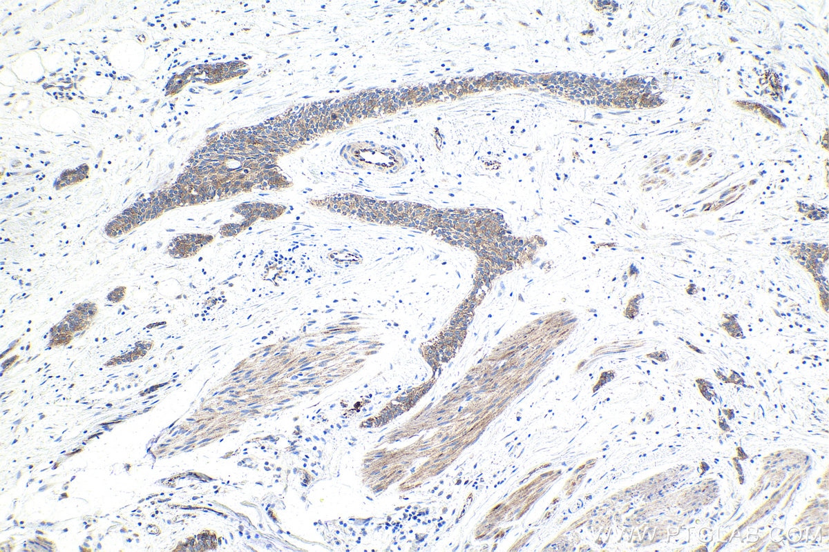 Immunohistochemistry (IHC) staining of human urothelial carcinoma tissue using STEAP3 Polyclonal antibody (28478-1-AP)