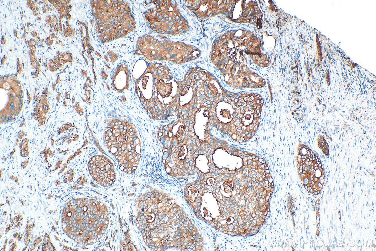 Immunohistochemistry (IHC) staining of human prostate cancer tissue using STEAP4 Polyclonal antibody (11944-1-AP)