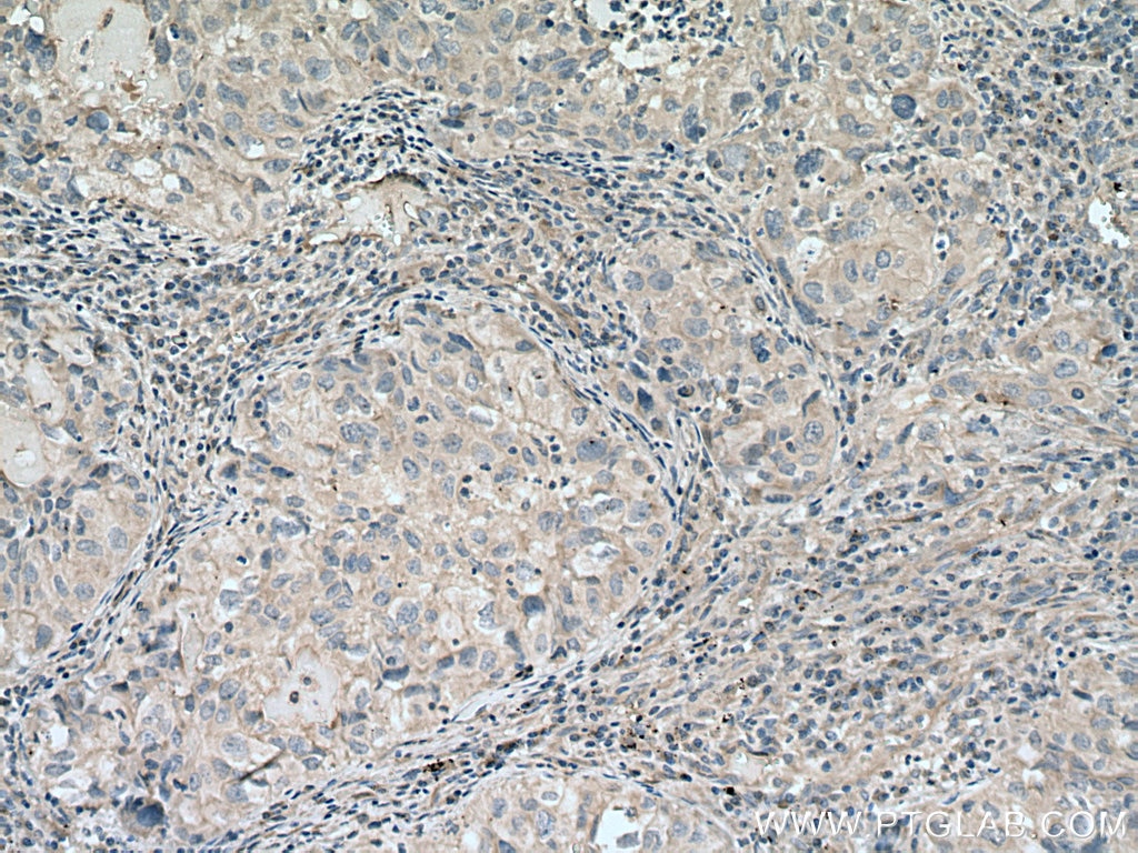 Immunohistochemistry (IHC) staining of human lung cancer tissue using STIL Monoclonal antibody (66876-1-Ig)