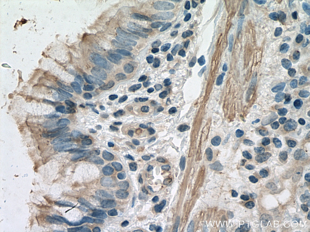 Immunohistochemistry (IHC) staining of human lung cancer tissue using STIL Monoclonal antibody (66876-1-Ig)