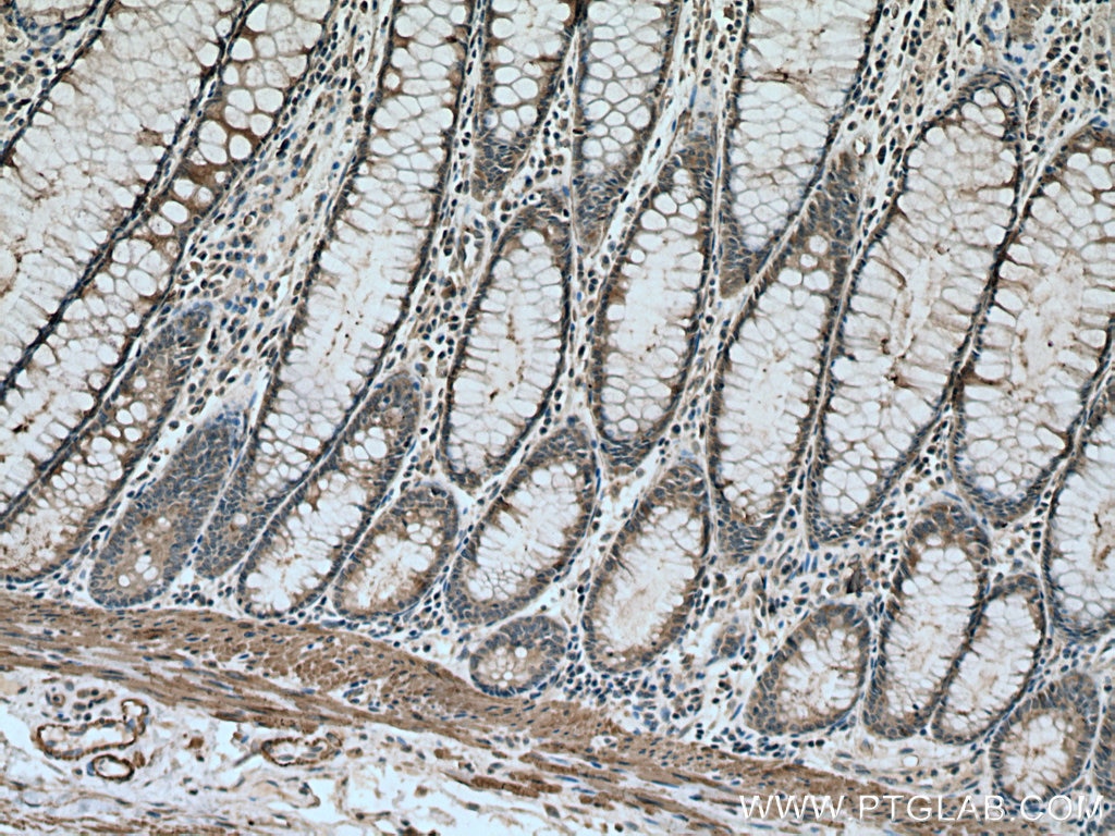 Immunohistochemistry (IHC) staining of human colon cancer tissue using STIL Monoclonal antibody (66876-1-Ig)