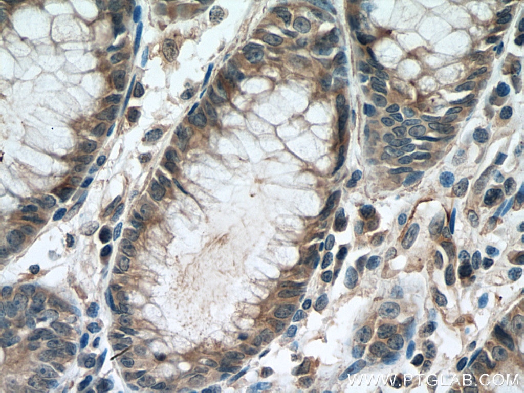 Immunohistochemistry (IHC) staining of human colon cancer tissue using STIL Monoclonal antibody (66876-1-Ig)