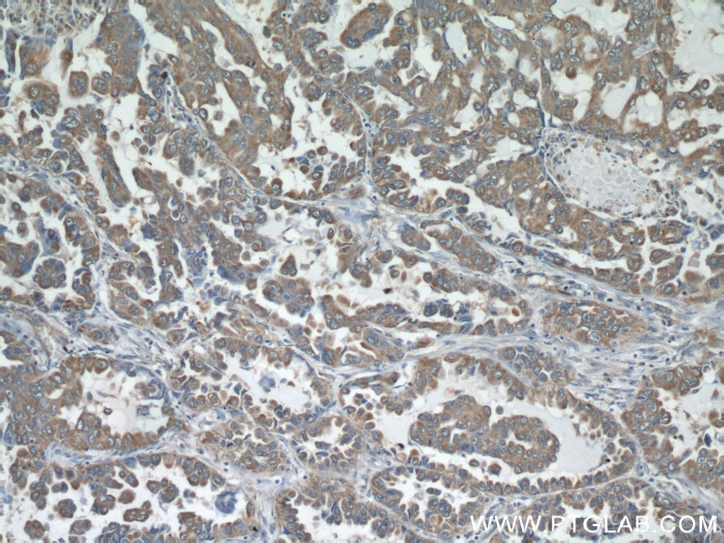 Immunohistochemistry (IHC) staining of human lung cancer tissue using STIM1 Polyclonal antibody (11565-1-AP)