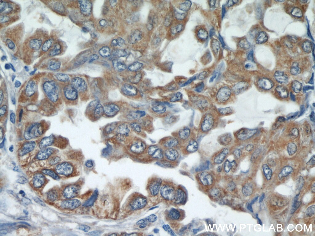 Immunohistochemistry (IHC) staining of human lung cancer tissue using STIM1 Polyclonal antibody (11565-1-AP)