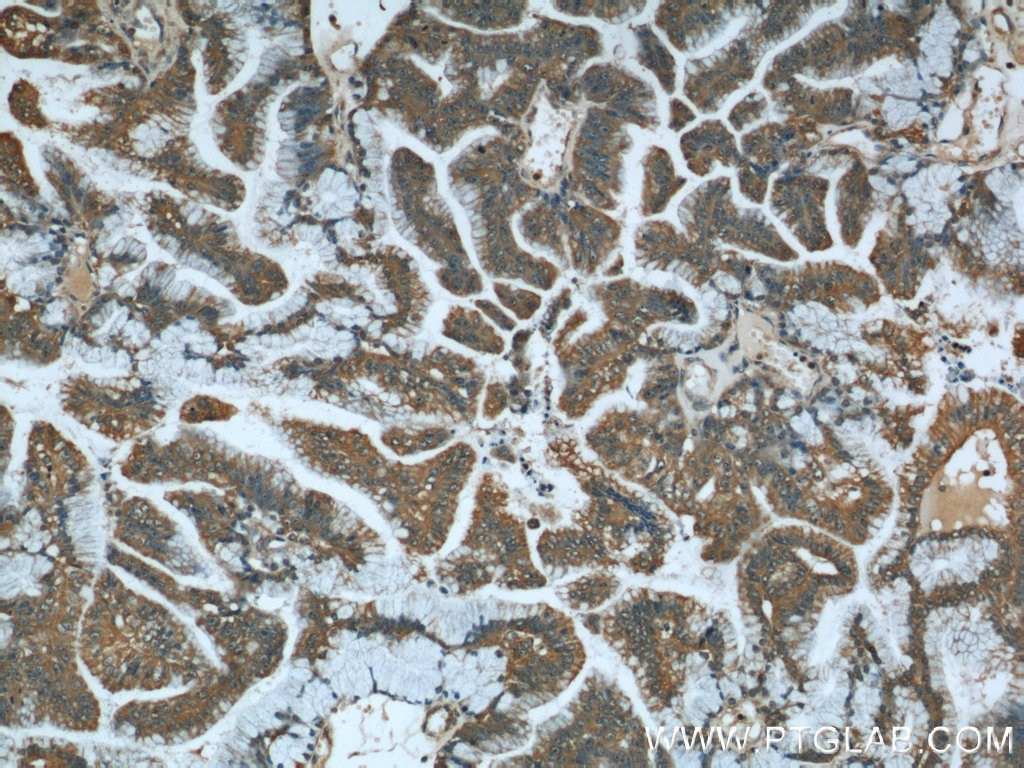 Immunohistochemistry (IHC) staining of human ovary tumor tissue using STIM1 Polyclonal antibody (11565-1-AP)