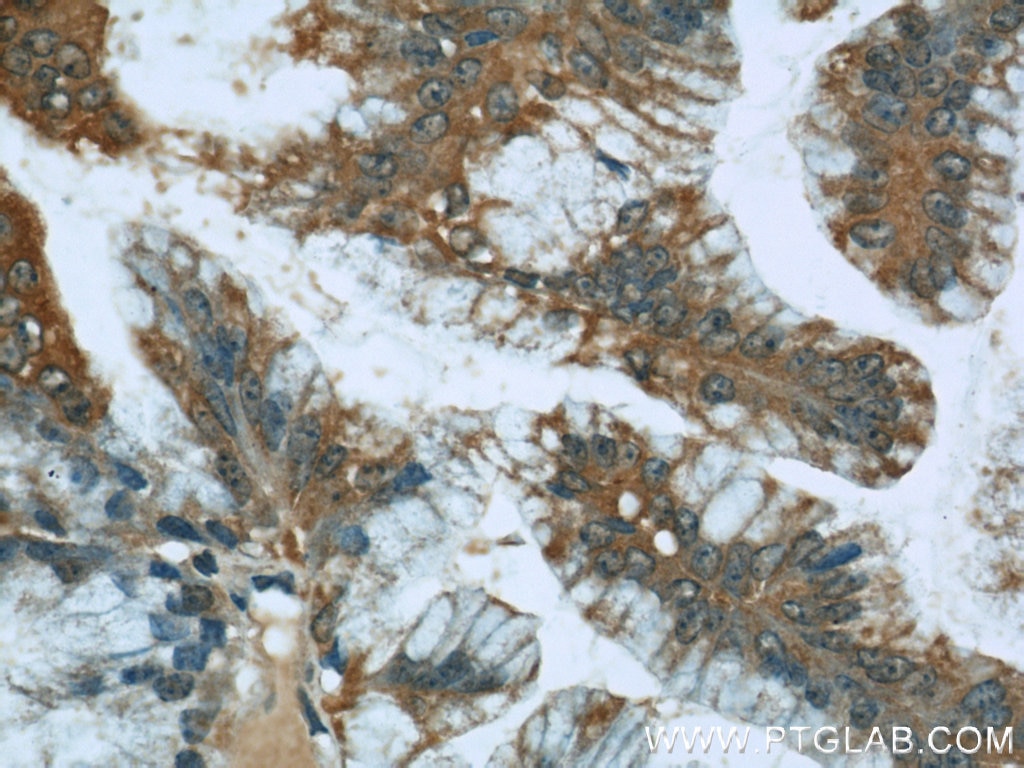 Immunohistochemistry (IHC) staining of human ovary tumor tissue using STIM1 Polyclonal antibody (11565-1-AP)