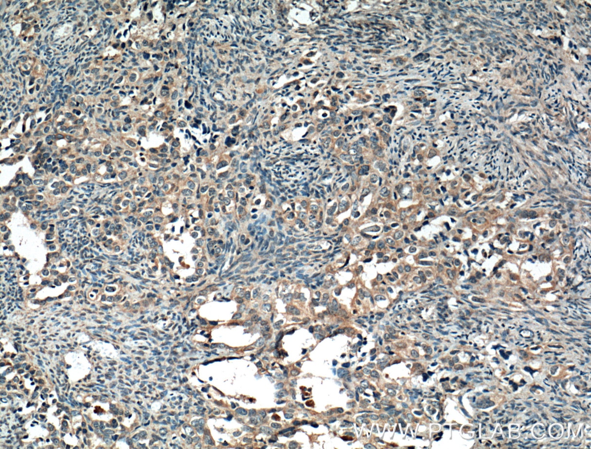 IHC staining of human ovary tumor using 66189-1-Ig