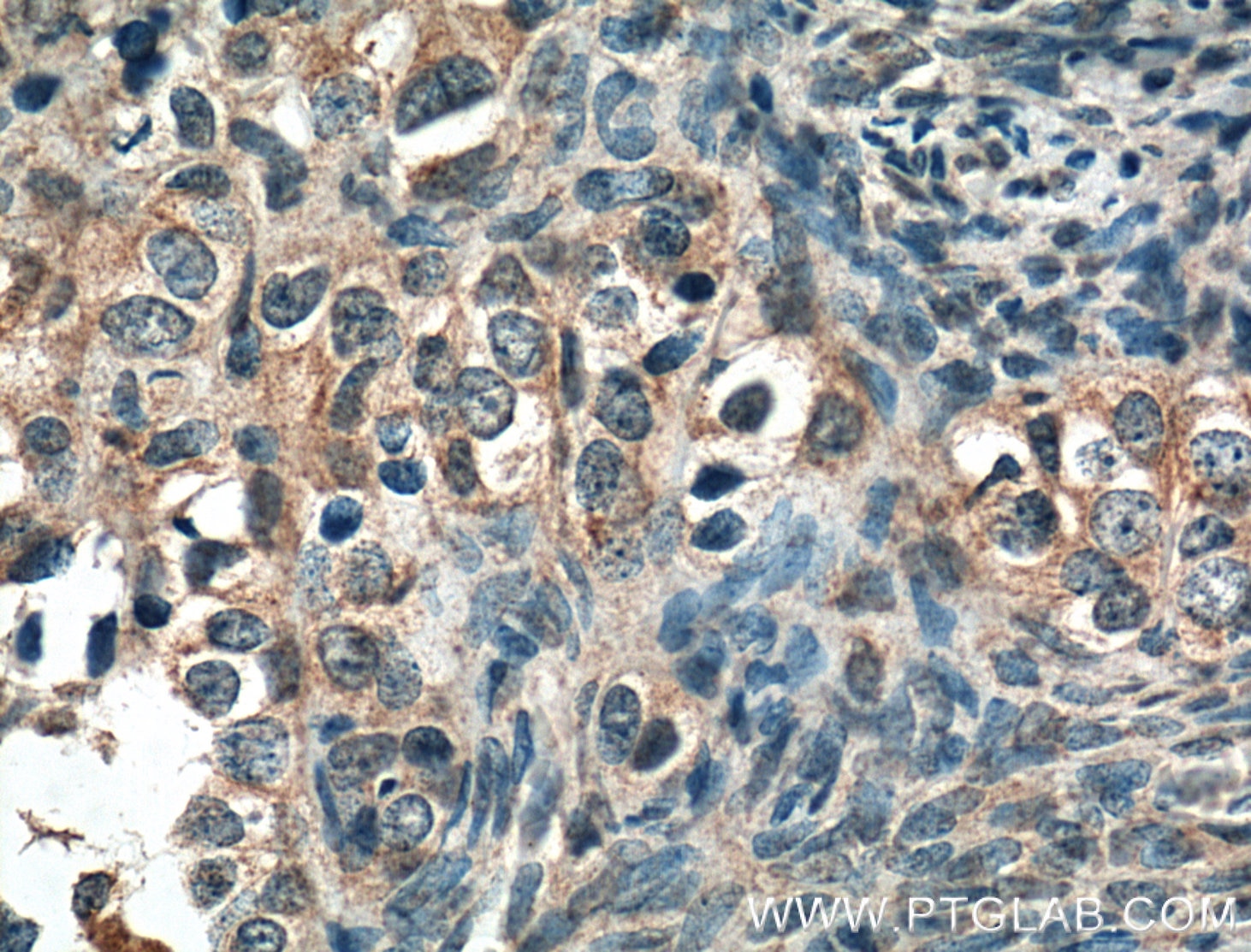 Immunohistochemistry (IHC) staining of human ovary tumor tissue using STIM1 Monoclonal antibody (66189-1-Ig)