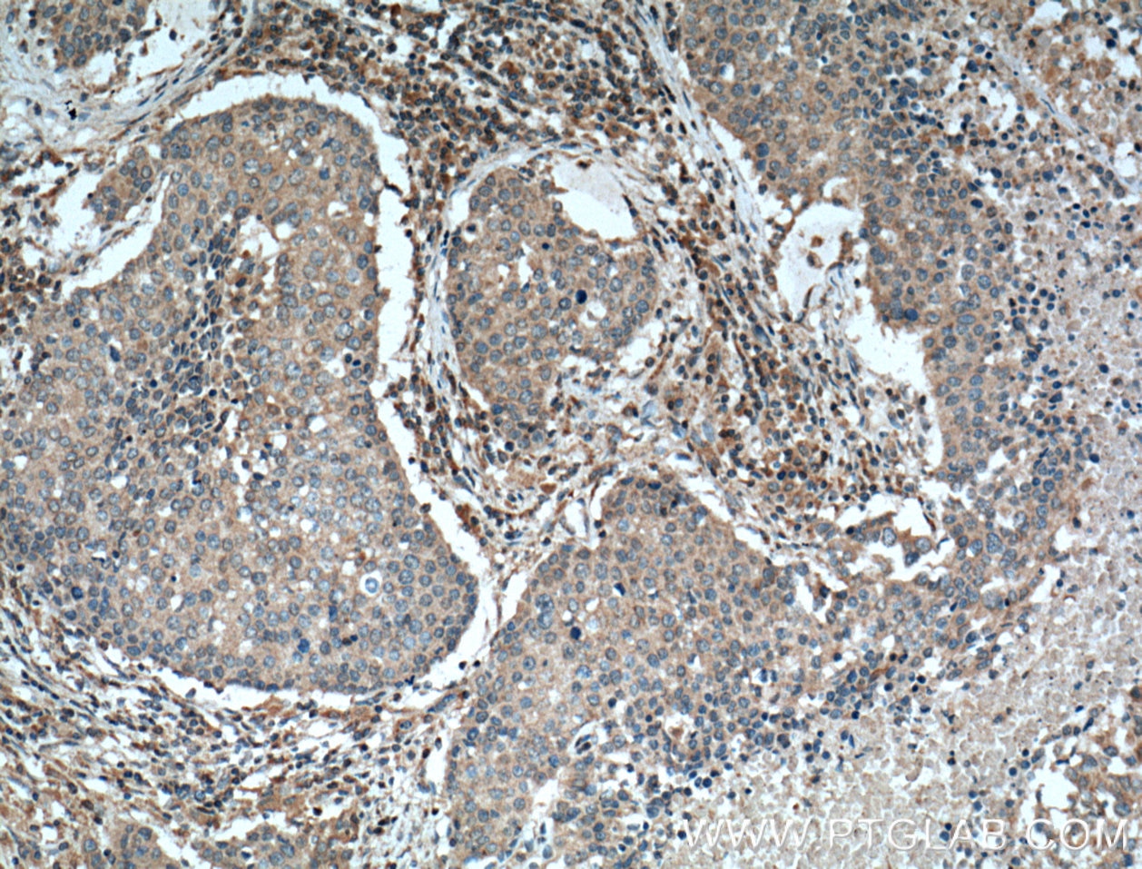 Immunohistochemistry (IHC) staining of human lung cancer tissue using STIM1 Monoclonal antibody (66189-1-Ig)