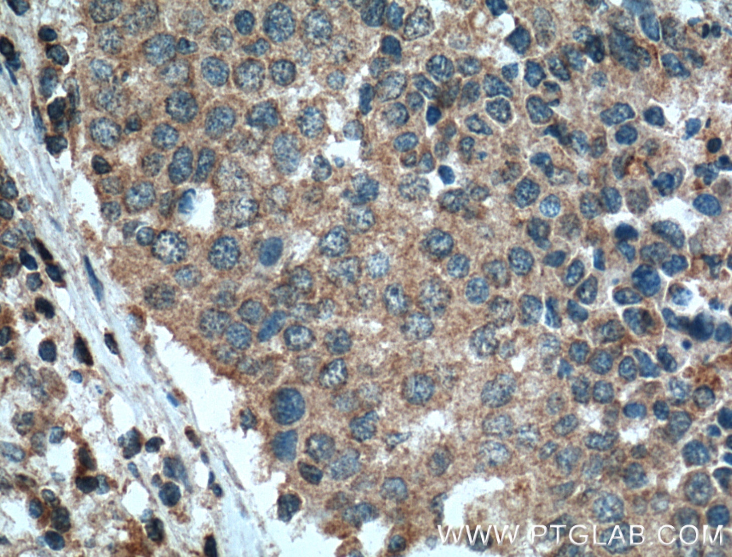 Immunohistochemistry (IHC) staining of human lung cancer tissue using STIM1 Monoclonal antibody (66189-1-Ig)