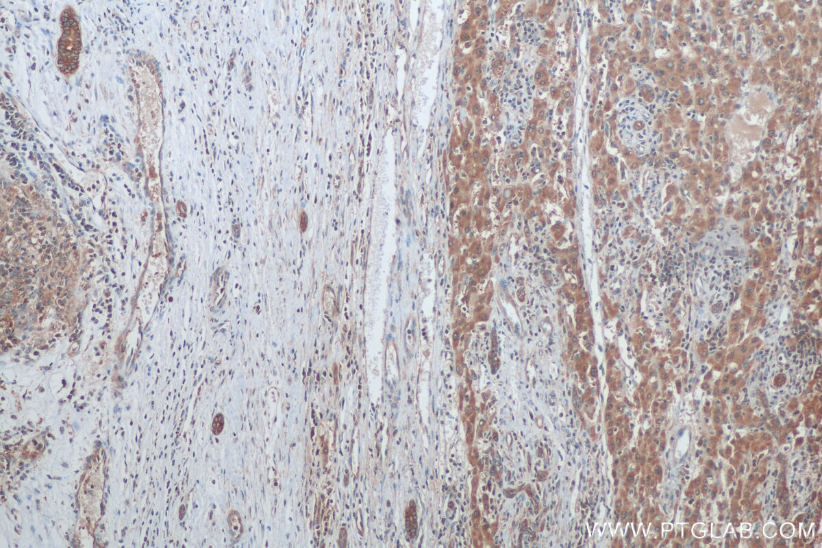 IHC staining of human liver cancer using 15218-1-AP