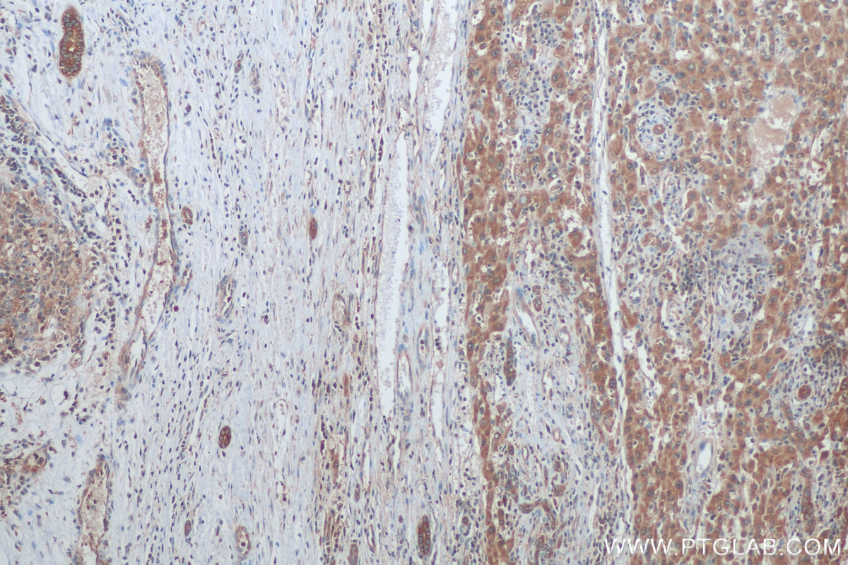 Immunohistochemistry (IHC) staining of human liver cancer tissue using STIP1 Polyclonal antibody (15218-1-AP)
