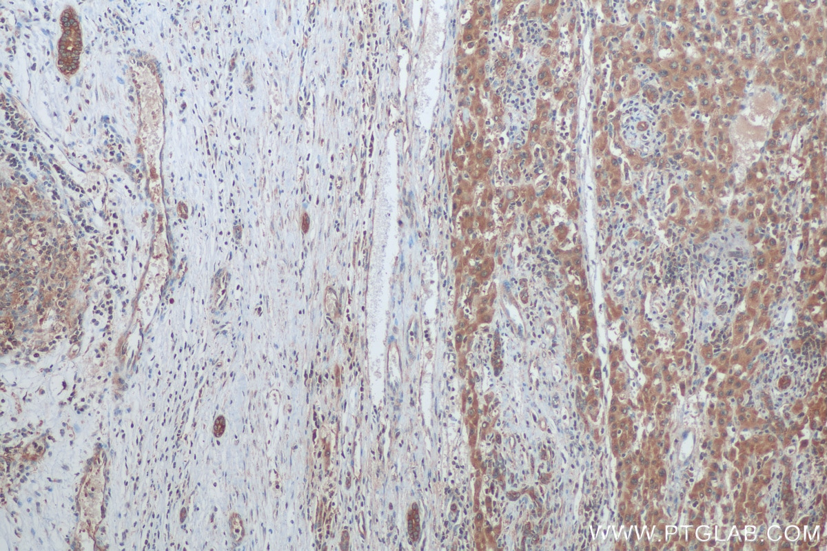 Immunohistochemistry (IHC) staining of human liver cancer tissue using STIP1 Polyclonal antibody (15218-1-AP)