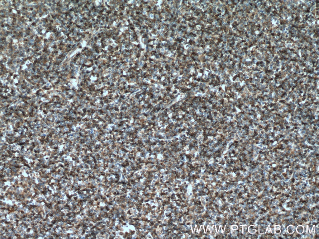 Immunohistochemistry (IHC) staining of human lymphoma tissue using STK10 Polyclonal antibody (25471-1-AP)