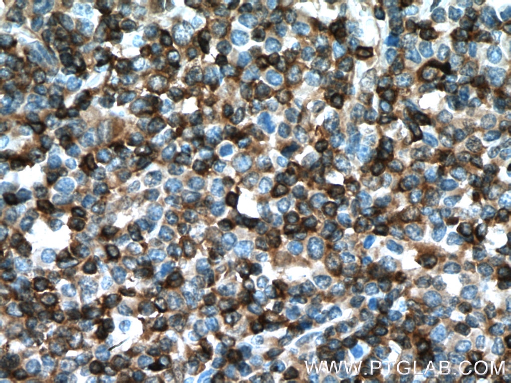 Immunohistochemistry (IHC) staining of human lymphoma tissue using STK10 Polyclonal antibody (25471-1-AP)