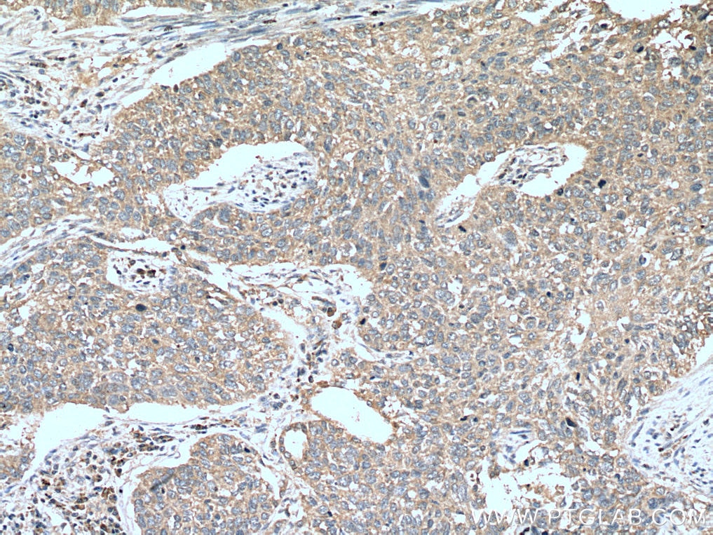 Immunohistochemistry (IHC) staining of human lung cancer tissue using STK11/LKB1 Polyclonal antibody (10746-1-AP)