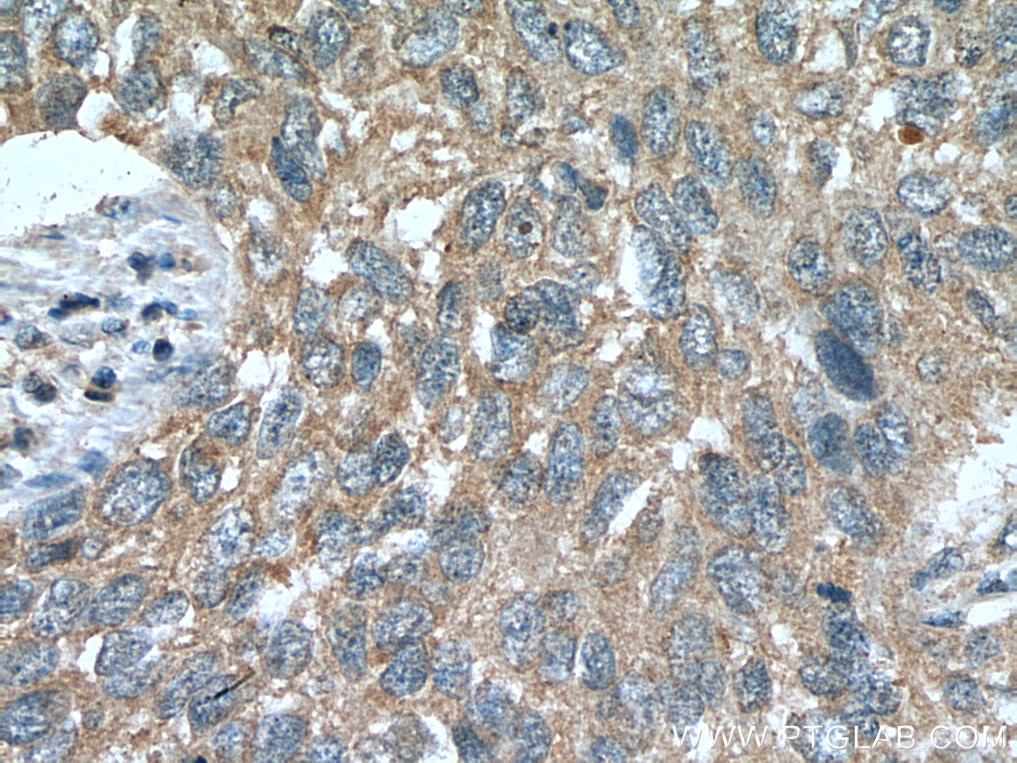 Immunohistochemistry (IHC) staining of human lung cancer tissue using STK11/LKB1 Polyclonal antibody (10746-1-AP)