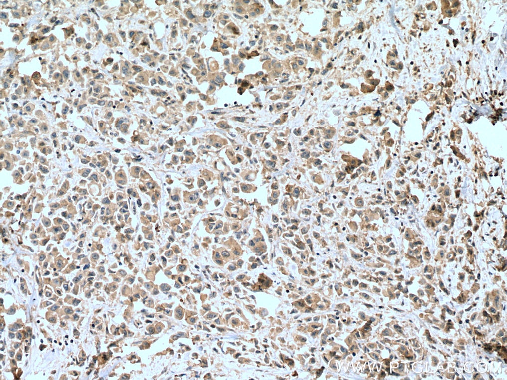 IHC staining of human breast cancer using 10746-1-AP