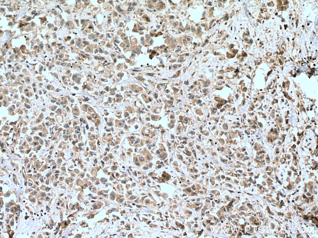 Immunohistochemistry (IHC) staining of human breast cancer tissue using STK11/LKB1 Polyclonal antibody (10746-1-AP)