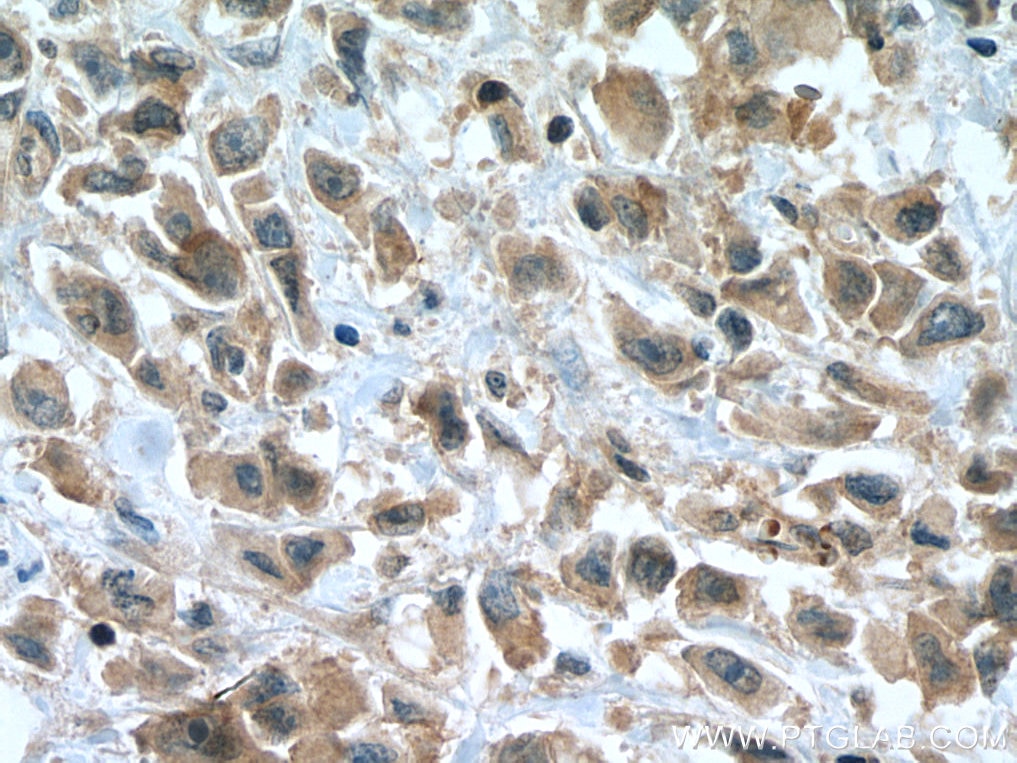 Immunohistochemistry (IHC) staining of human breast cancer tissue using STK11/LKB1 Polyclonal antibody (10746-1-AP)