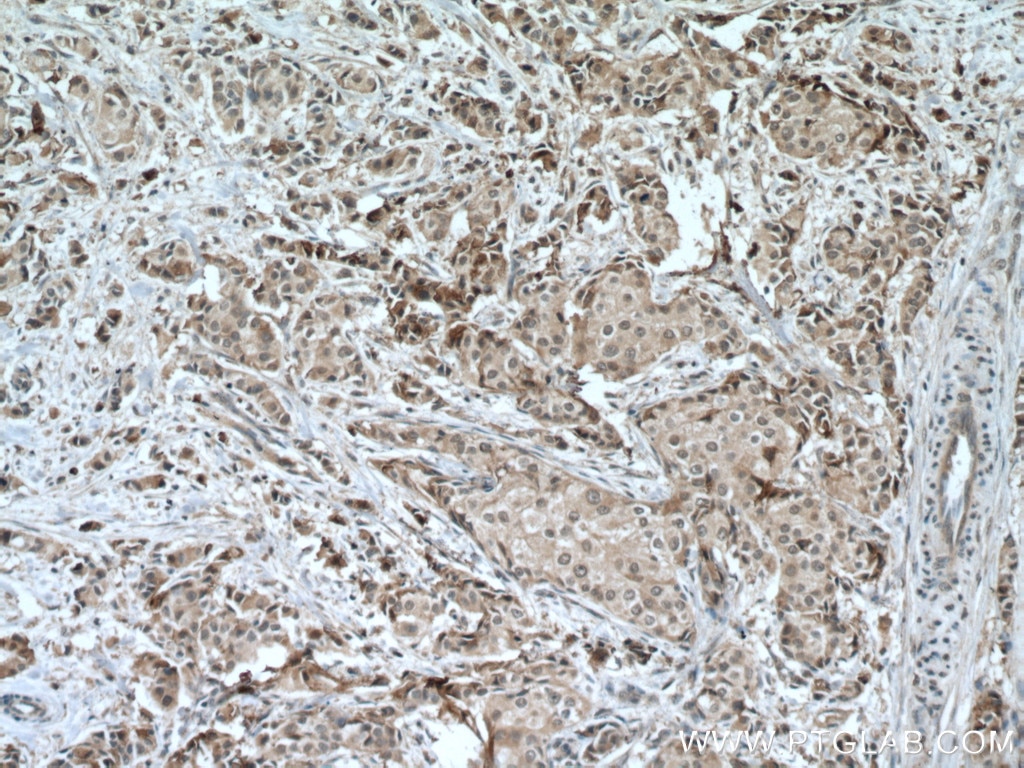 Immunohistochemistry (IHC) staining of human breast cancer tissue using STK11/LKB1 Monoclonal antibody (66719-1-Ig)