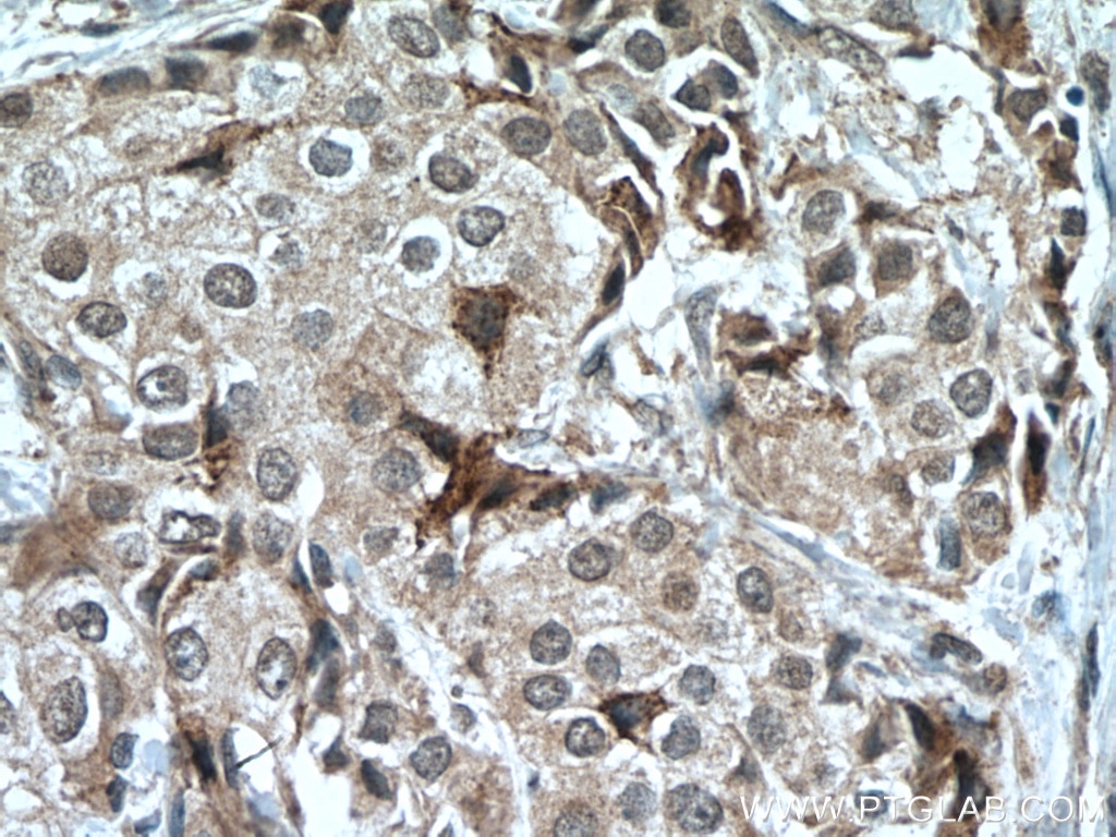 Immunohistochemistry (IHC) staining of human breast cancer tissue using STK11/LKB1 Monoclonal antibody (66719-1-Ig)
