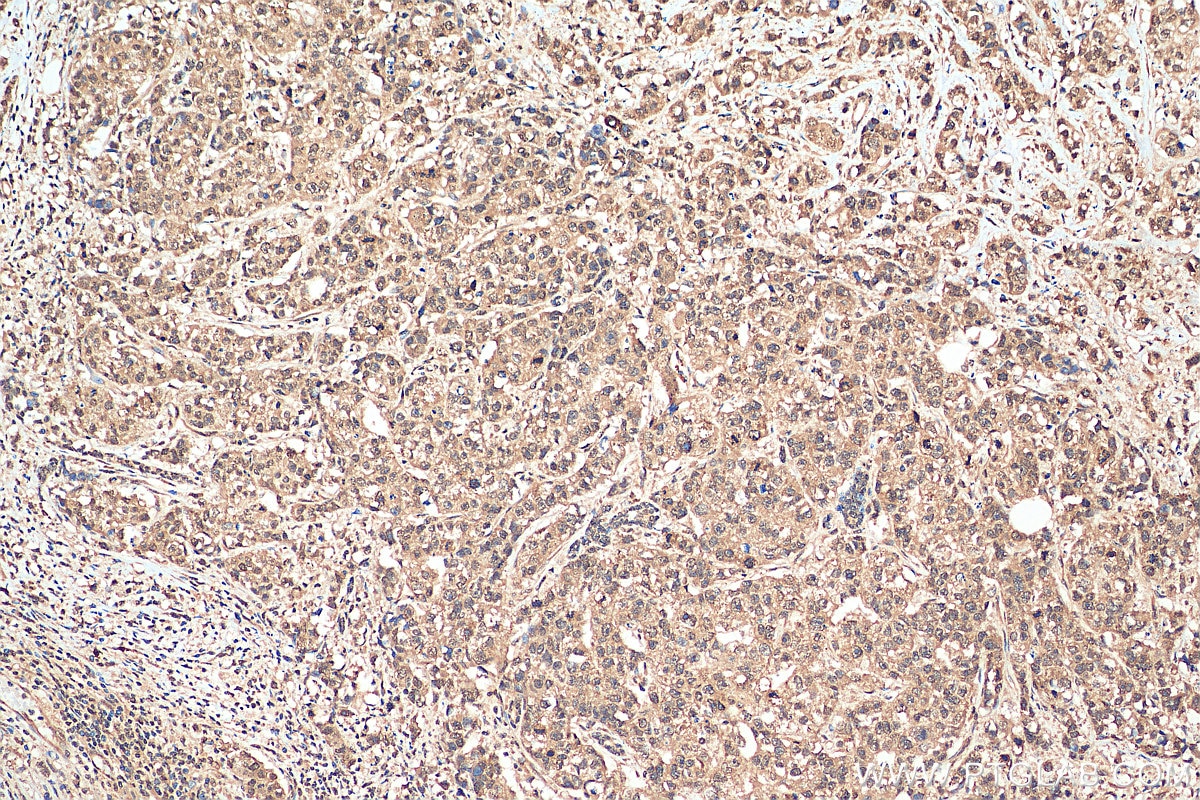 Immunohistochemistry (IHC) staining of human breast cancer tissue using STK11/LKB1 Polyclonal antibody (29323-1-AP)