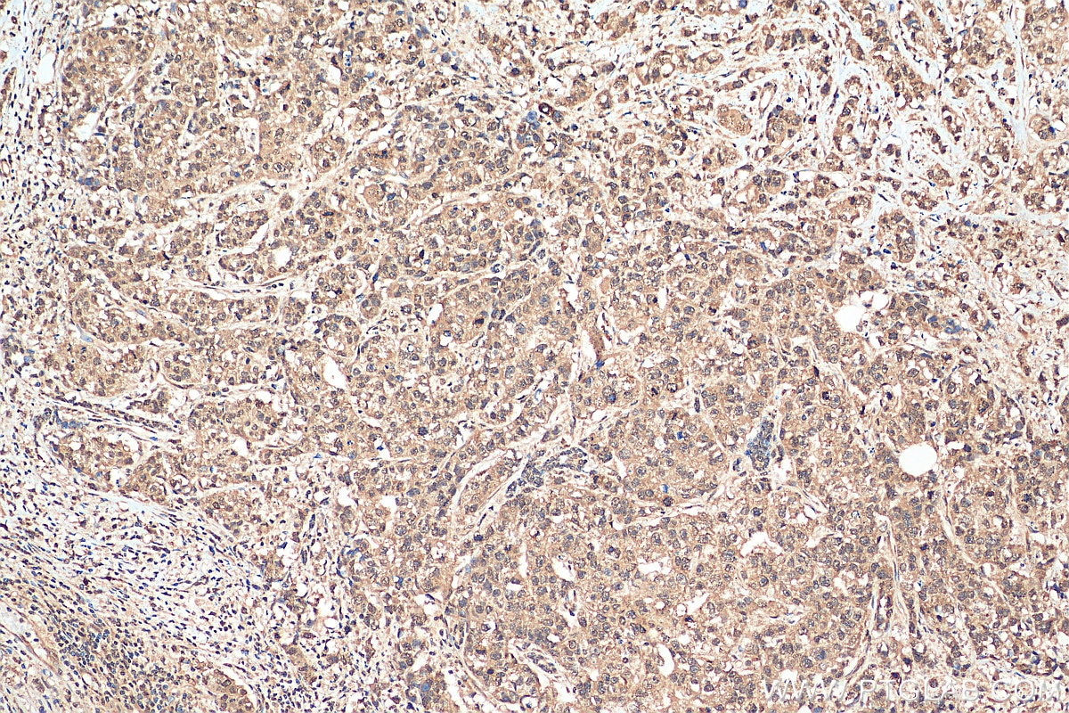 IHC staining of human breast cancer using 29323-1-AP