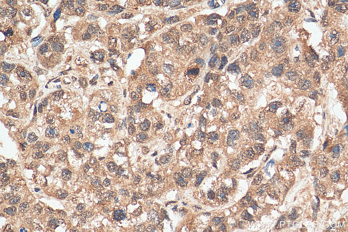 IHC staining of human breast cancer using 29323-1-AP