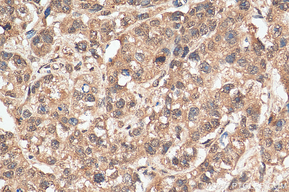 Immunohistochemistry (IHC) staining of human breast cancer tissue using STK11/LKB1 Polyclonal antibody (29323-1-AP)