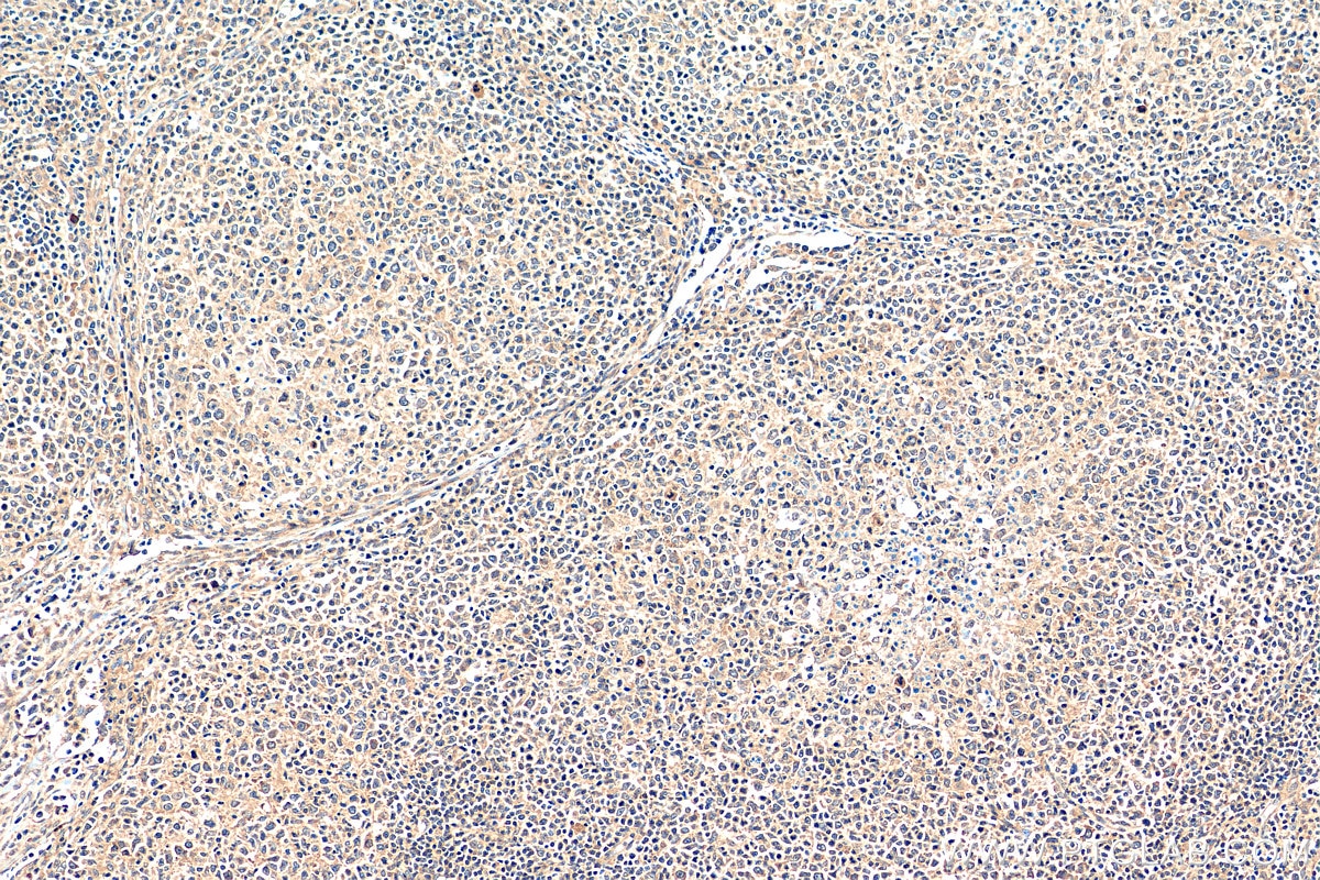 Immunohistochemistry (IHC) staining of human lymphoma tissue using STK11/LKB1 Polyclonal antibody (29323-1-AP)