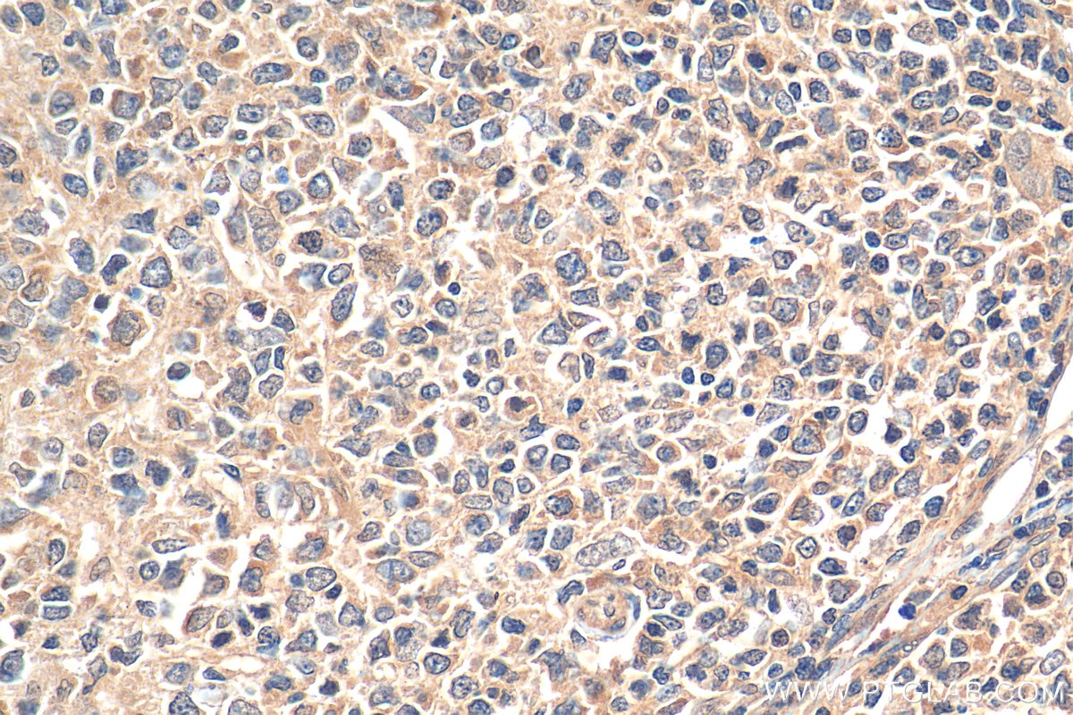 Immunohistochemistry (IHC) staining of human lymphoma tissue using STK11/LKB1 Polyclonal antibody (29323-1-AP)
