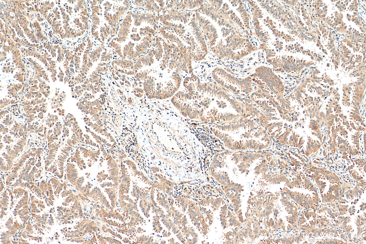 Immunohistochemistry (IHC) staining of human lung cancer tissue using STK11/LKB1 Polyclonal antibody (29323-1-AP)