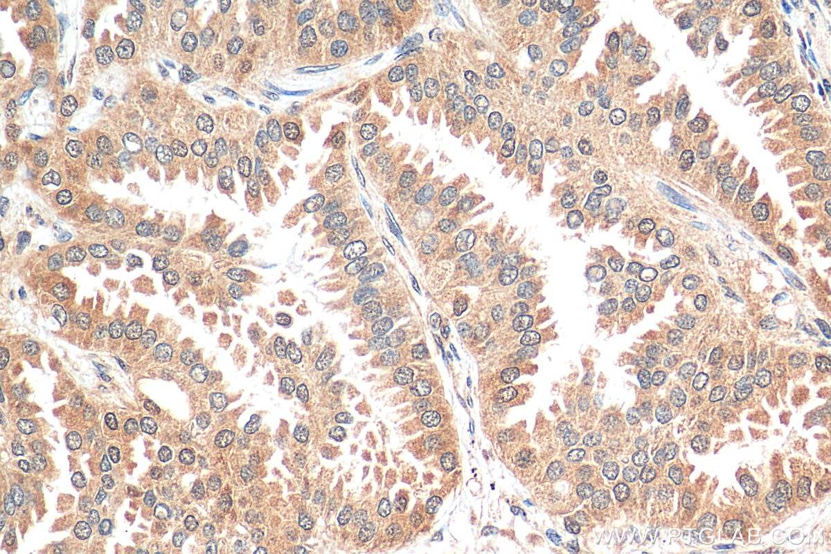 Immunohistochemistry (IHC) staining of human lung cancer tissue using STK11/LKB1 Polyclonal antibody (29323-1-AP)