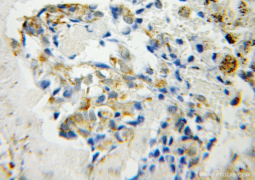Immunohistochemistry (IHC) staining of human lung cancer tissue using STK11IP Polyclonal antibody (12464-1-AP)