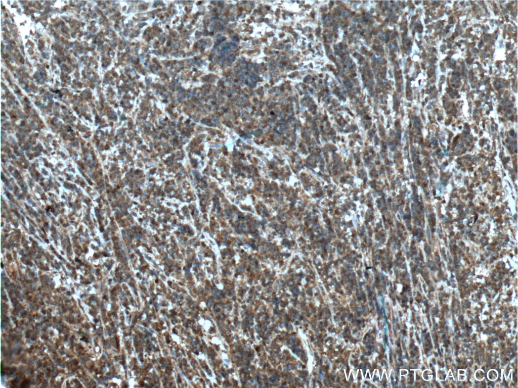 Immunohistochemistry (IHC) staining of human lymphoma tissue using STK17B Polyclonal antibody (26600-1-AP)