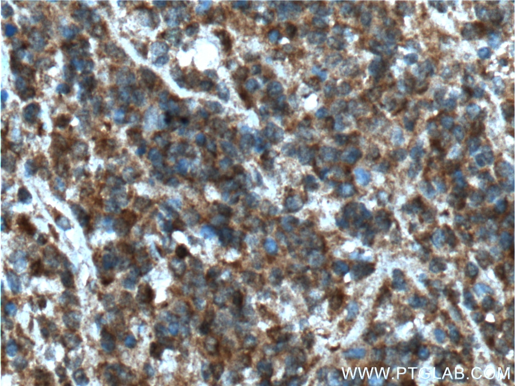 Immunohistochemistry (IHC) staining of human lymphoma tissue using STK17B Polyclonal antibody (26600-1-AP)