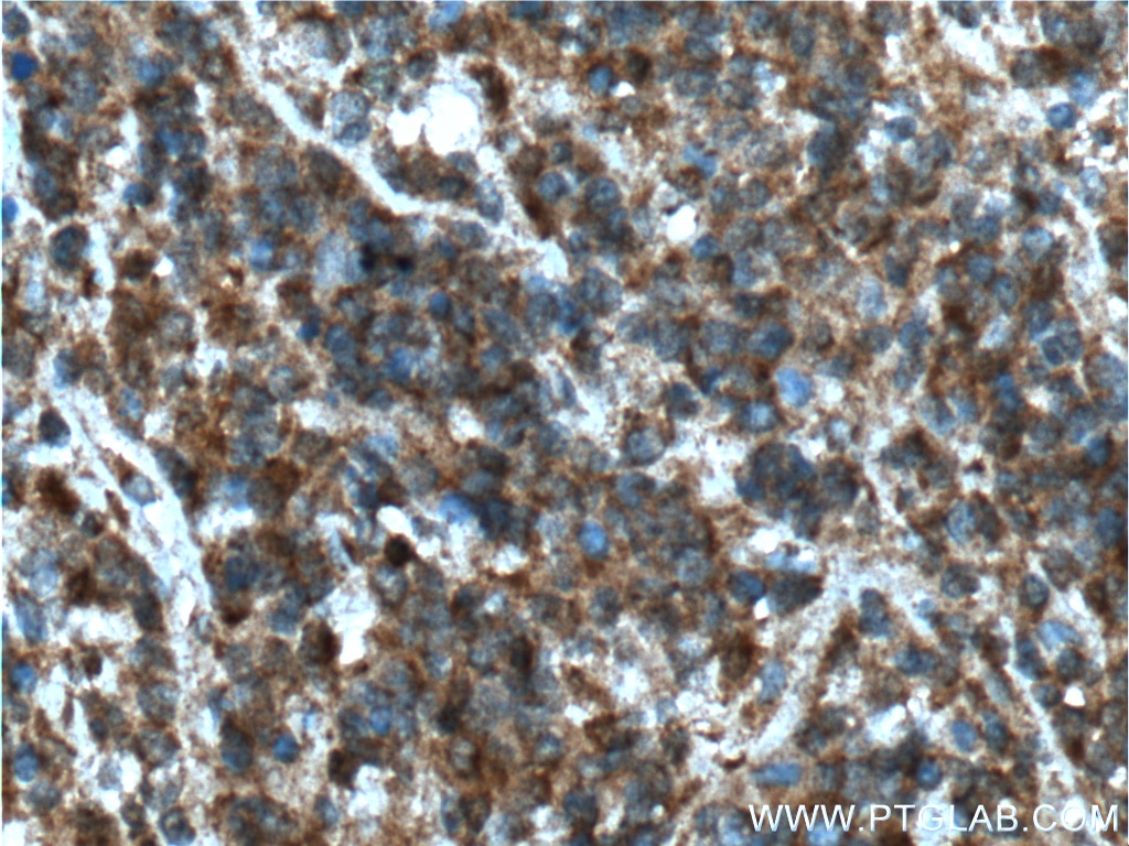 IHC staining of human lymphoma using 26600-1-AP