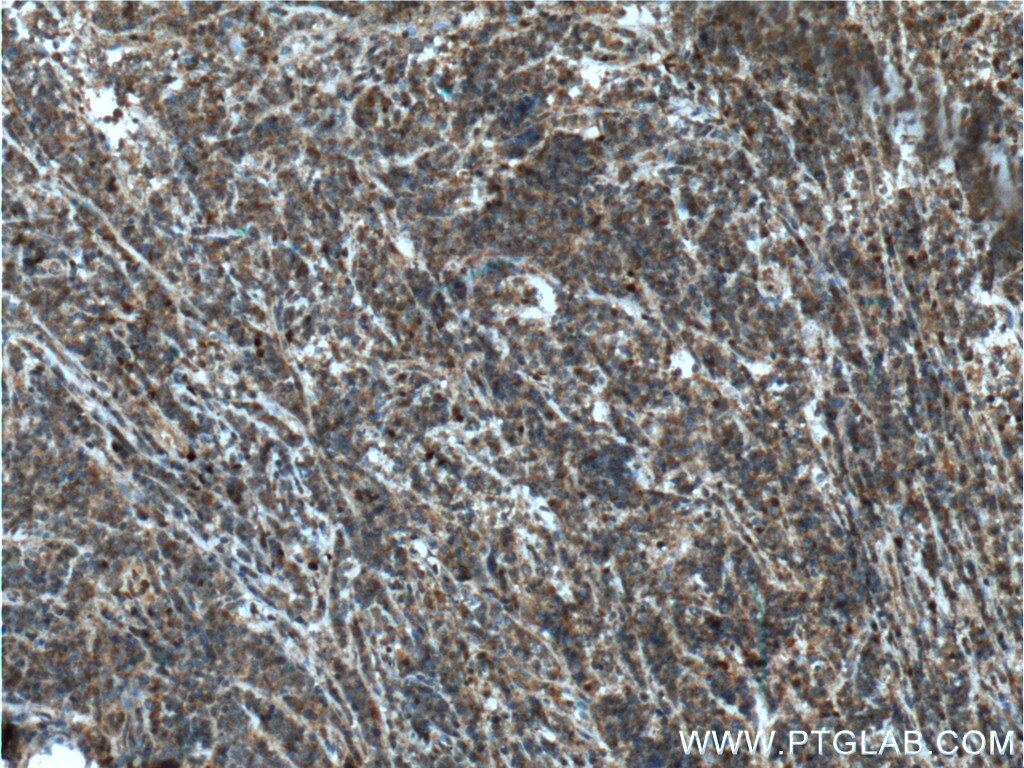 Immunohistochemistry (IHC) staining of human lymphoma tissue using STK17B Polyclonal antibody (26600-1-AP)