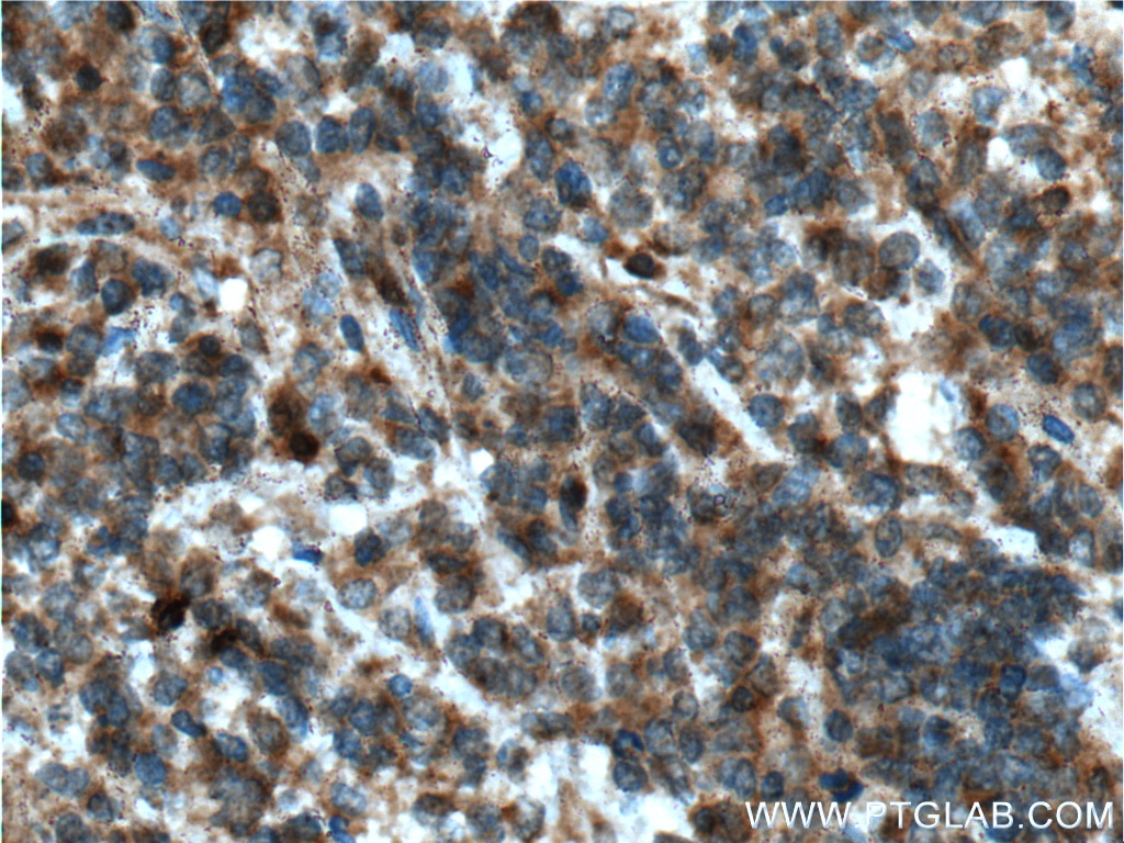 Immunohistochemistry (IHC) staining of human lymphoma tissue using STK17B Polyclonal antibody (26600-1-AP)