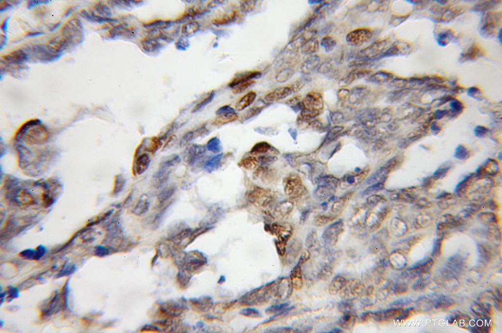Immunohistochemistry (IHC) staining of human ovary tumor tissue using STK3 Polyclonal antibody (12097-1-AP)