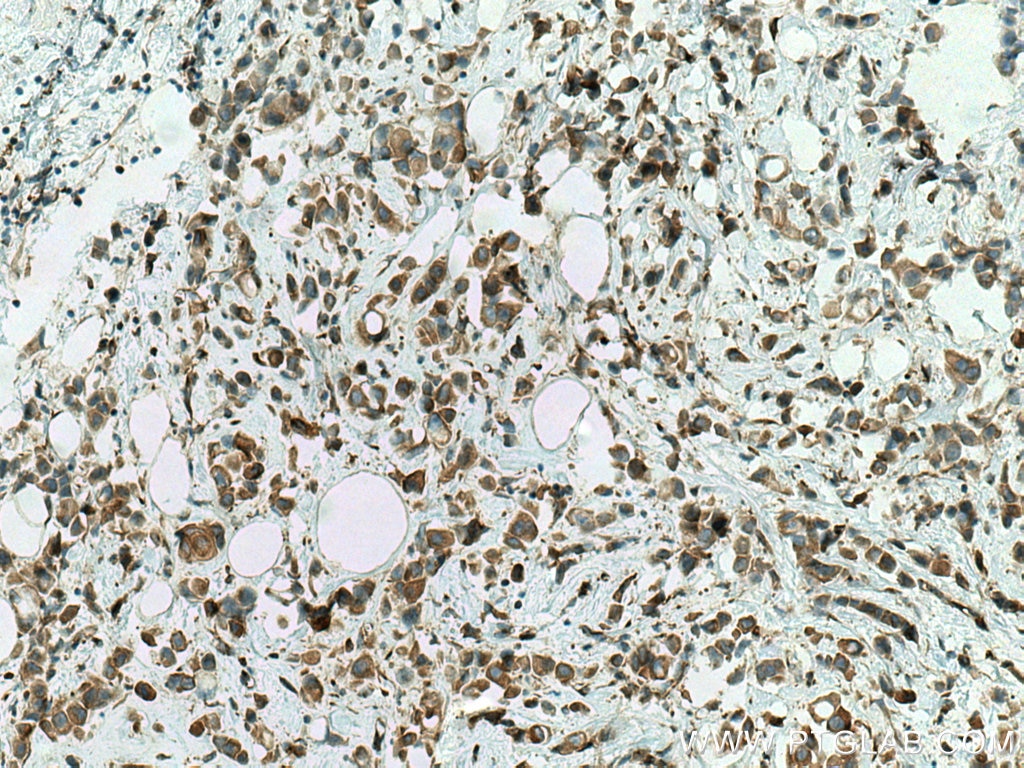 Immunohistochemistry (IHC) staining of human breast cancer tissue using STK32A Monoclonal antibody (67528-1-Ig)