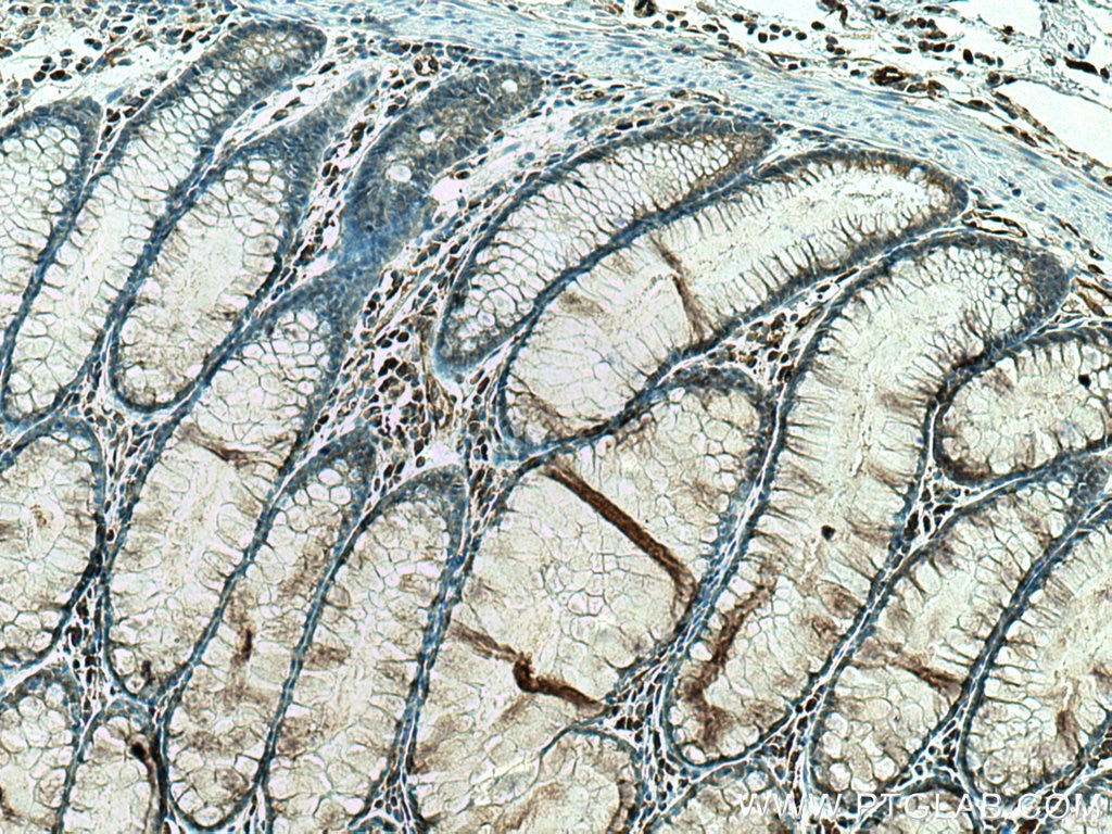 Immunohistochemistry (IHC) staining of human colon cancer tissue using STK32A Monoclonal antibody (67528-1-Ig)