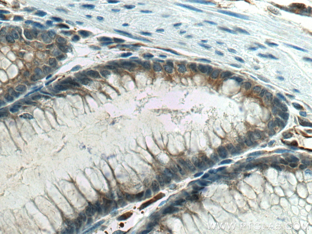 Immunohistochemistry (IHC) staining of human colon cancer tissue using STK32A Monoclonal antibody (67528-1-Ig)