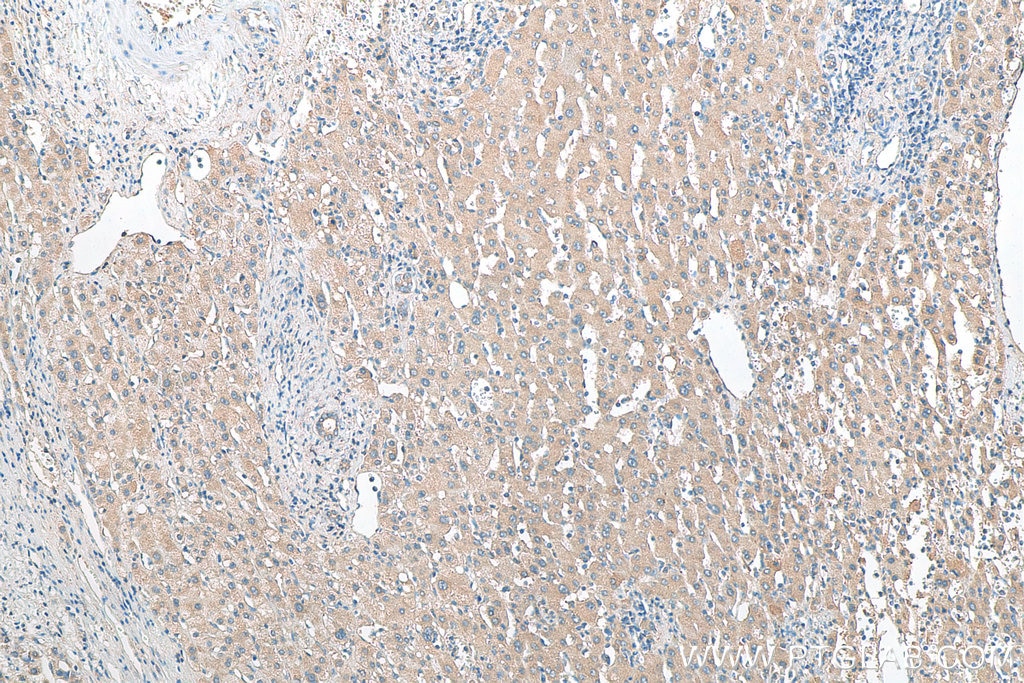 Immunohistochemistry (IHC) staining of human liver cancer tissue using STK33 Polyclonal antibody (12857-1-AP)