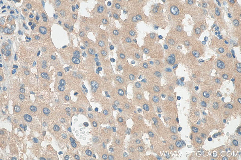 Immunohistochemistry (IHC) staining of human liver cancer tissue using STK33 Polyclonal antibody (12857-1-AP)