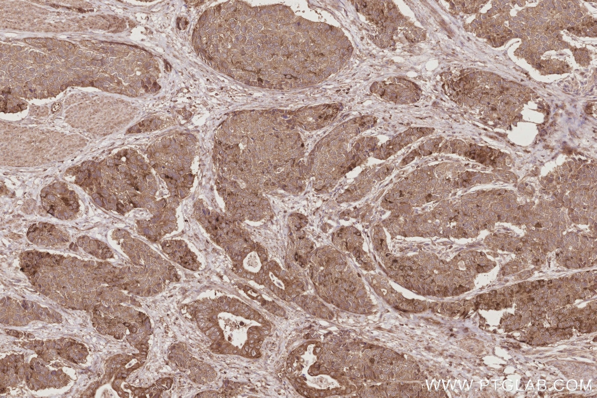 Immunohistochemistry (IHC) staining of human stomach cancer tissue using STK33 Polyclonal antibody (12857-1-AP)