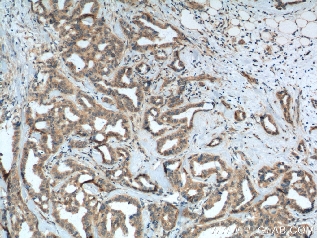 IHC staining of human breast cancer using 11105-1-AP