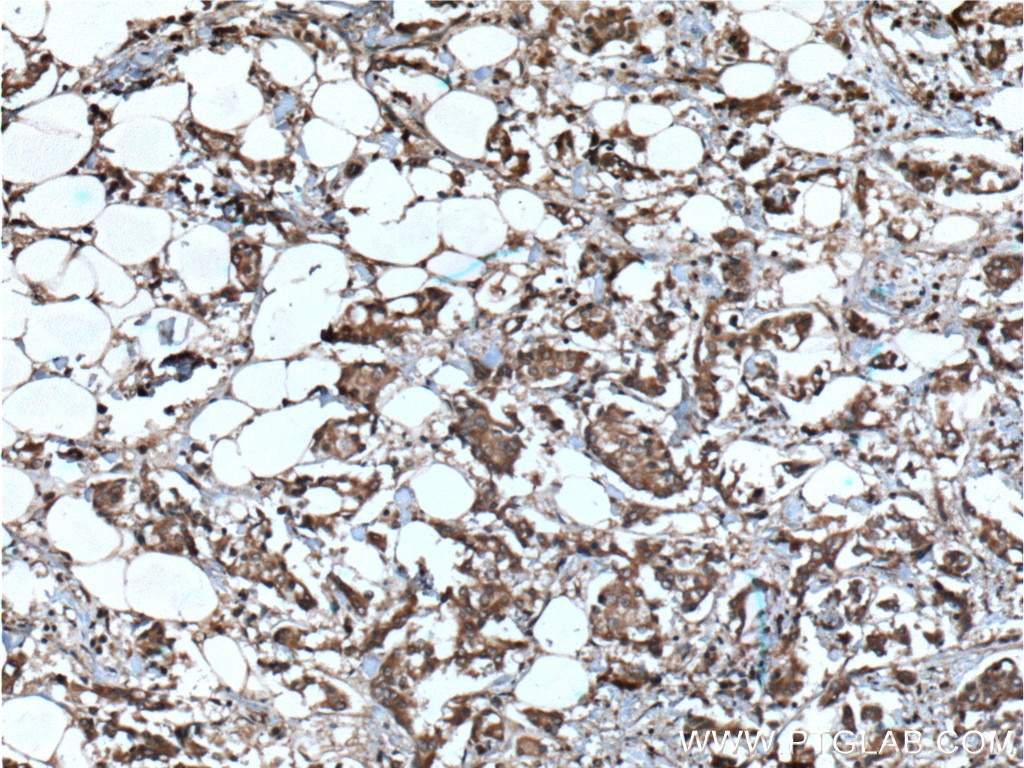 Immunohistochemistry (IHC) staining of human breast cancer tissue using STK38 Polyclonal antibody (55335-1-AP)