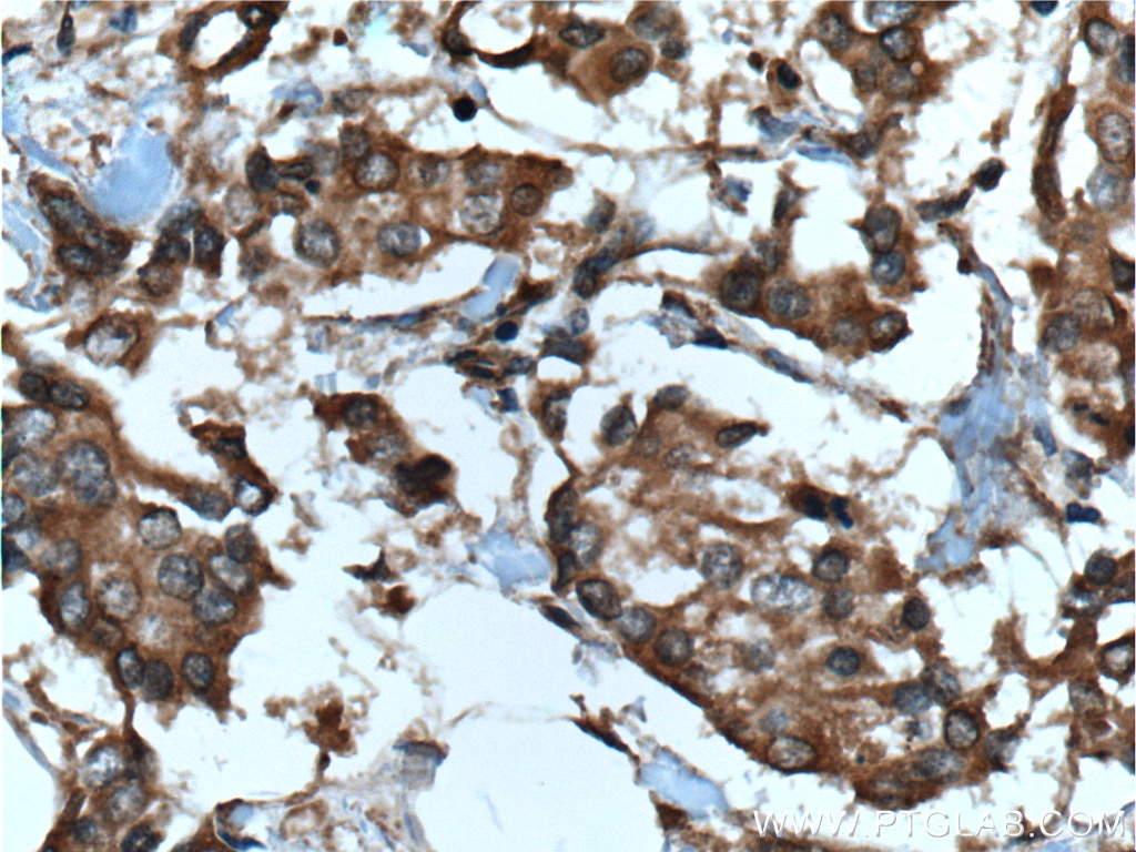 Immunohistochemistry (IHC) staining of human breast cancer tissue using STK38 Polyclonal antibody (55335-1-AP)